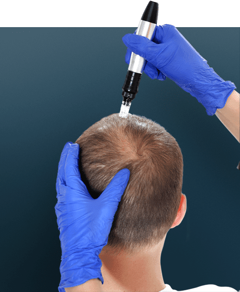 img-mmp-tratamento-para-queda-de-cabelo-em-sp-02